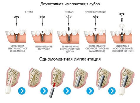 Этапы имплантации зубов - всё о процедуре имплантации – Клиника ЕС