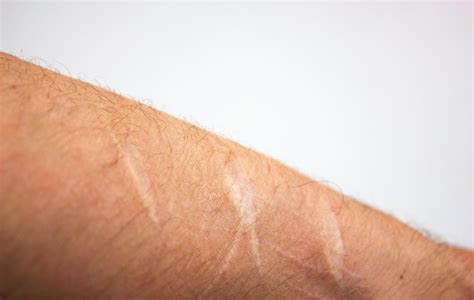 Premium Photo | Scars from cuts on the arm Old traces of a skin cut on ...