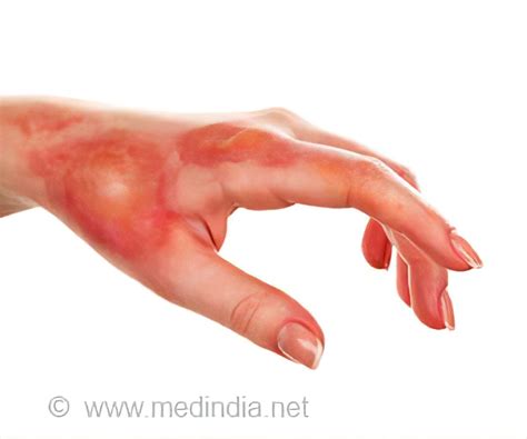 Necrotizing Fasciitis Hand