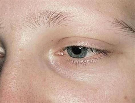 Why itchy eyebrows: causes and treatment