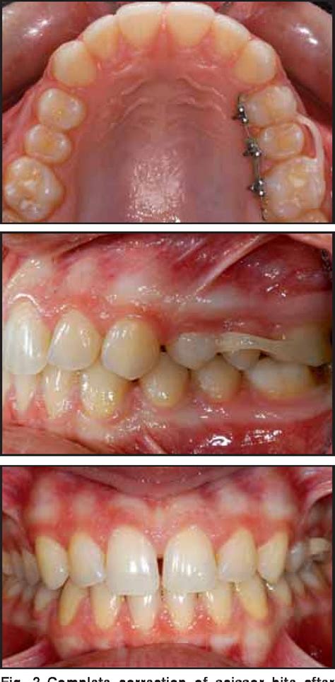 Figure 1 from One-appointment correction of a scissor bite with 2D lingual brackets and fiber ...