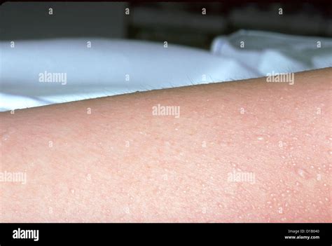 BLISTERS Stock Photo: 52487344 - Alamy