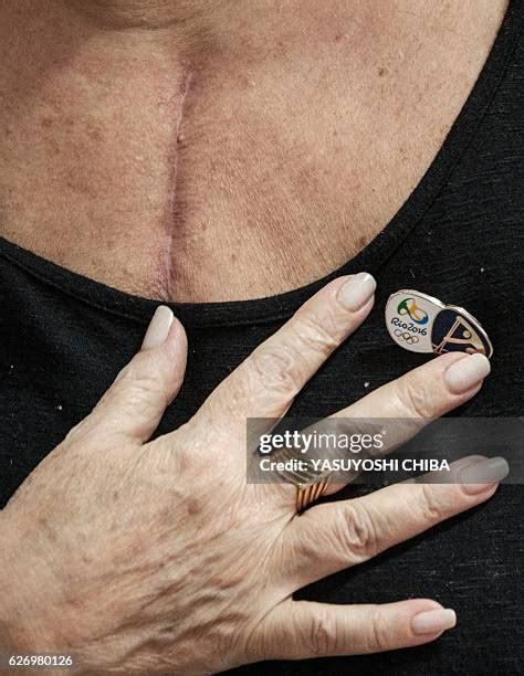 Heart Transplant Scar Photos and Premium High Res Pictures - Getty Images