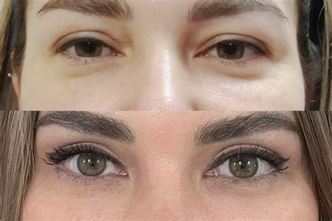 Круговая блефаропластика. Стоимость операции блефаропластика верхних и ...