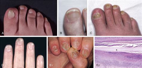 Toenail Abnormalities - Clinical Tree