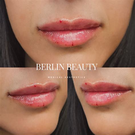 How much are Lip Filler in NJ | Lip Injections NJ - Berlin Beauty