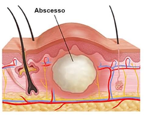 O Que Significa Abscesso - O Que é ABSCESSO? Drenagem... Tratamentos | BR da Nutrição