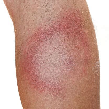 The Erythema Migrans Rash Lyme Disease Stock Photo & More Pictures of ...