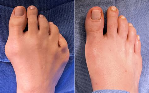 Webbed Toe Seperation Surgery | Syndactyly Surgery | Joined Toes