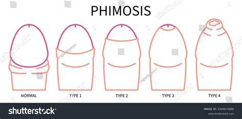 Phimosis And Paraphimosis