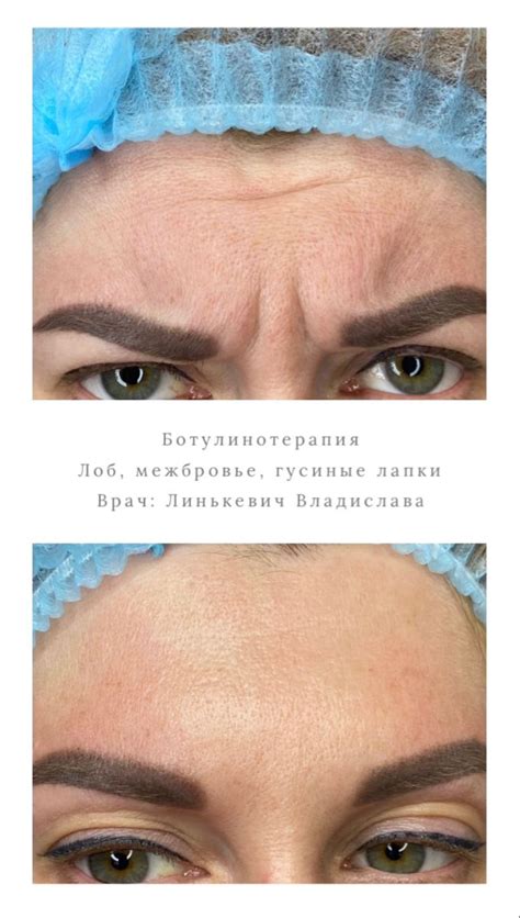 Ботулинотерапия в Одессе