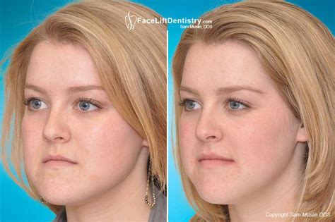 change  shape   face  surgery