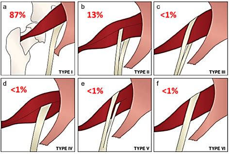 Variant Sciatic Nerve Anatomy in Relation to the Piriformis Muscle on