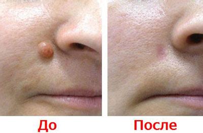 Фиброма кожи – что это такое? Симптомы, диагностика и особенности ...