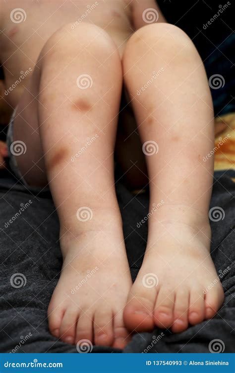 Bruises on the Legs of the Boy Stock Image - Image of knee, fingers ...