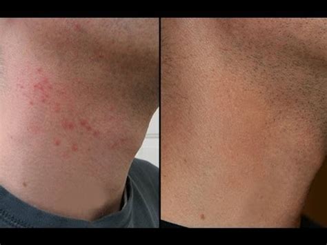 Razor Bumps On Neck Treatment