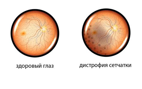 Причины и симптомы дистрофии сетчатки глаза. 2023 | ВКонтакте