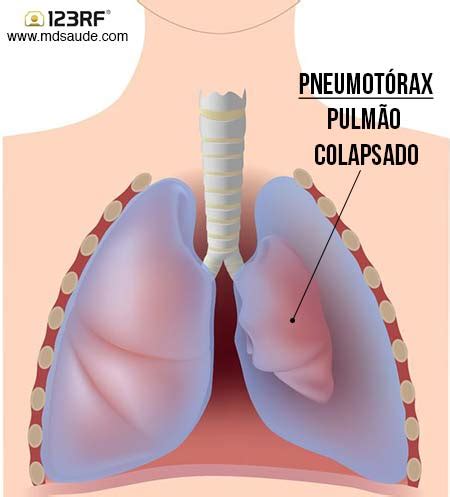 Pneumotórax O Que É - Pneumotórax | O que é, causas, sintomas e tratamento