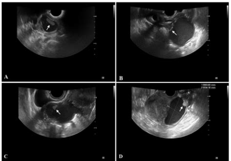 punctate echogenic foci   wall     solid appearing