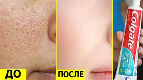 Как убрать черные точки на лице | Как убрать рубцы на лице | Как убрать ...