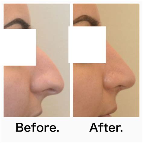 Before after pictures of rhinopasty nose jobs in Calgary