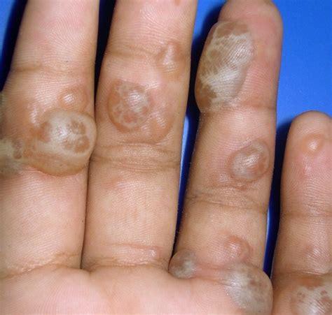 Blisters on Hands | Medical Point