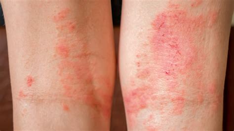 Atopic Dermatitis Relief
