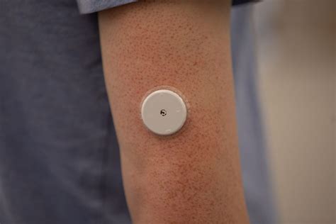 Continuous glucose monitoring: benefits and drawbacks explained