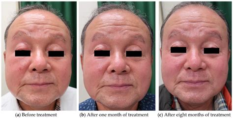Jessner Lymphocytic Infiltrate