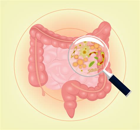 ¿Qué es la enfermedad inflamatoria intestinal?