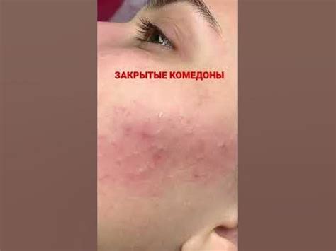 Закрытые комедоны нужно удалять , сами они не исчезнут. - YouTube