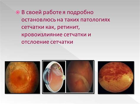 Презентация - Патология сетчатки » Привет Студент!