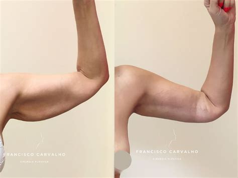 Plástica Nos Braços Antes E Depois