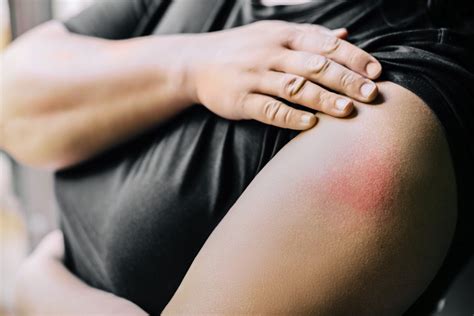 Ozempic® Injection Site Reactions: Symptoms & Solutions