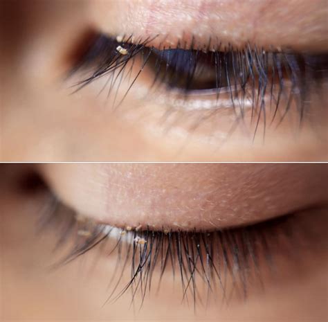 Doctors Warn About Dangers And Spread Of Eyelash Lice - Mikey Live