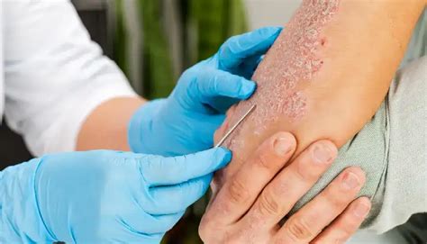 Dermatitis Doctor In Bhubaneswar | Irritation Treatment