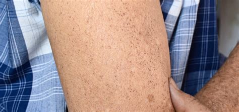 brown spots   skin called tracking