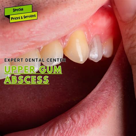 Bump On Upper Gums: Bumps On Gums – PEKB