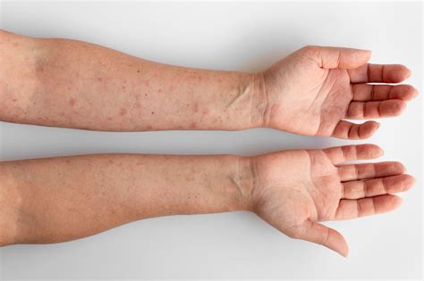 dermatite atopica causas sintomas  tratamentos vuelo pharma