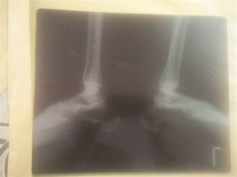 Ask a Radiologist Online for Calcaneal Spur