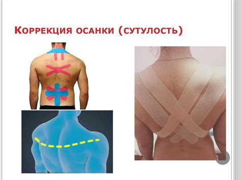 Тейпирование поясницы схема - 93 фото