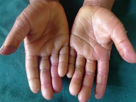 Rare Skin Diseases