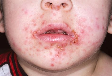 Pereba Na Boca O Que Pode Ser - Impetigo (Broto, pereba, piodermite) – ObservaPed