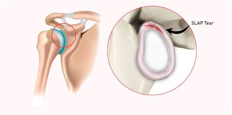 SLAP tear (Superior Labrum Anterior and Posterior) - MHT