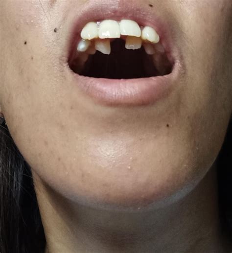Receding chin : r/orthotropics