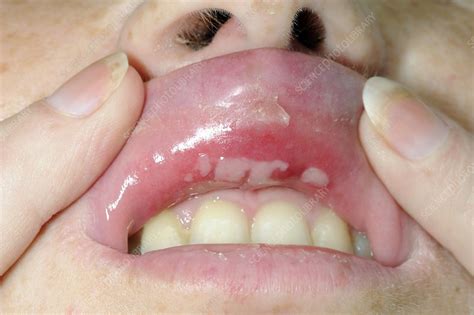 Aphthous ulcers inside upper lip - Stock Image - C010/6680 - Science ...