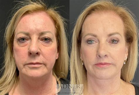 blepharoplasty