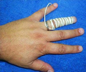 ring removal wikem