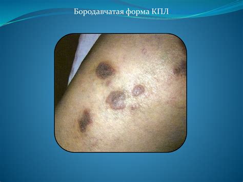 5_Лекция_псориаз,_красный_плоский_лишай - презентация онлайн