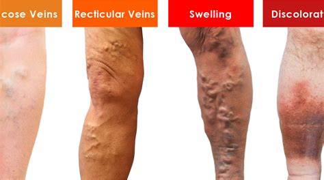 Can A Vein Burst In Your Arm at Sara Sheridan blog